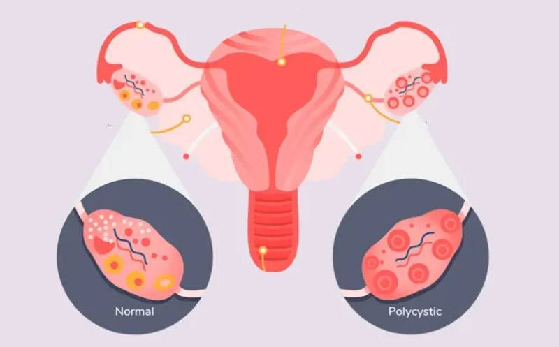 بهترین قرصها برای تنبلی تخمدان؛ از تنظیم هورمون تا کنترل علائم